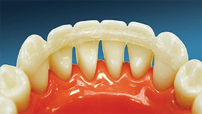 Periodontal Splinting