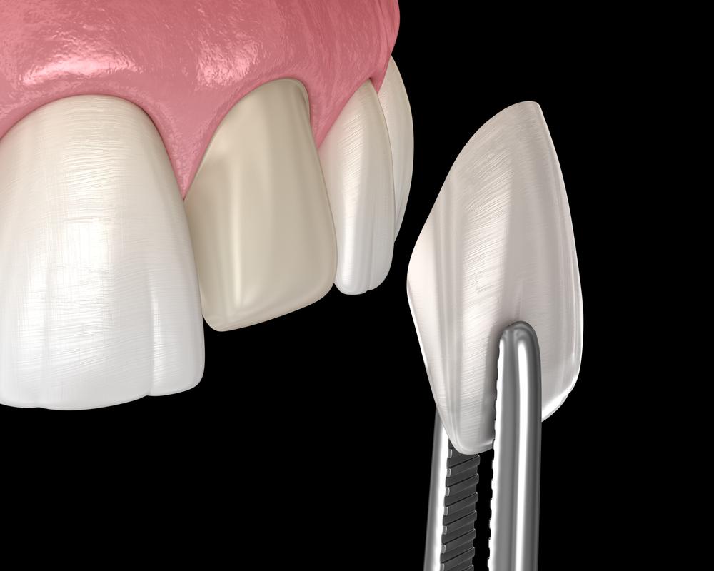 Porcelain Veneers