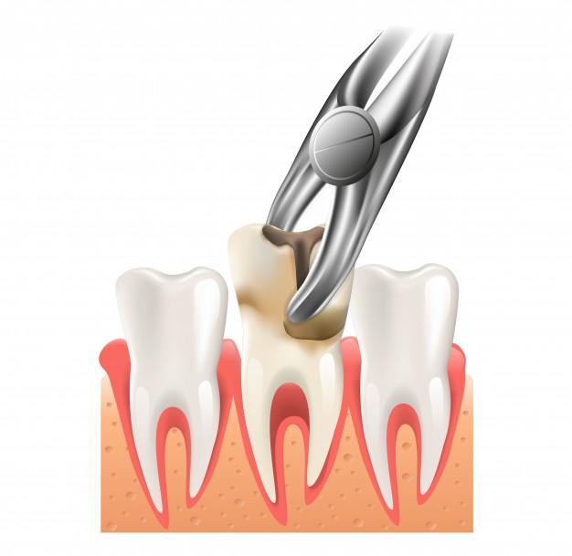 Tooth Extraction