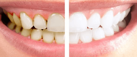 Teeth Cleaning (Scaling & Polishing)