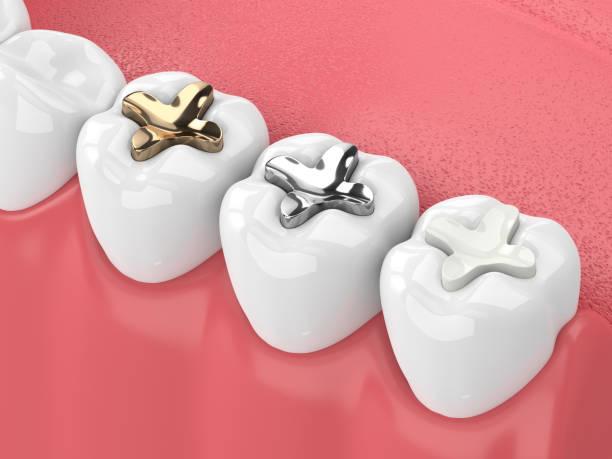 Tooth Coloured Fillings