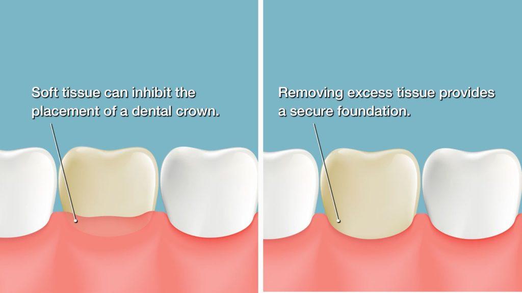 Crown Lengthening